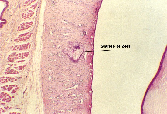 eyelid1.jpg (79134 bytes)